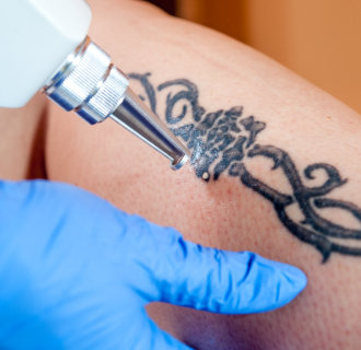 Tatoo Removal