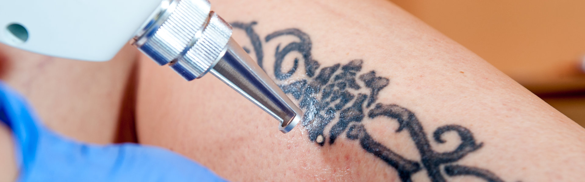 Tattoo Removal